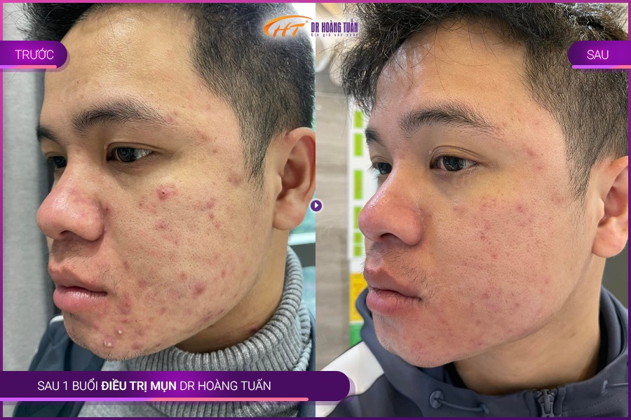 trị mụn bằng laser có hiệu quả không
